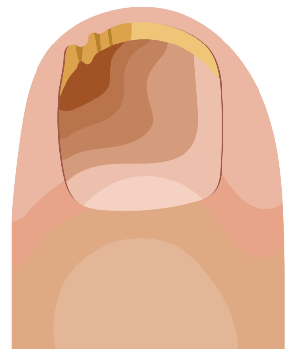 Das Bild zeigt eine grafische Darstellung eines Nagelpilzes.