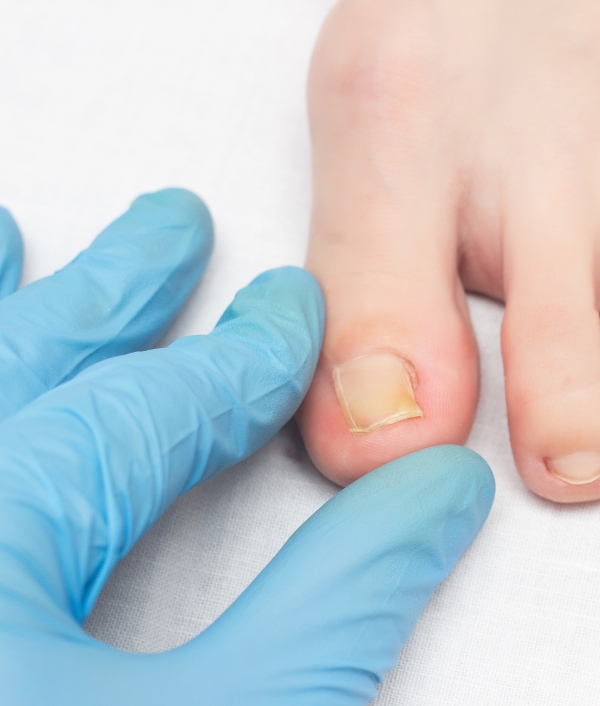 Auf dem Bild sieht man einen Zeh der von einem Nagelpilz befallen ist.