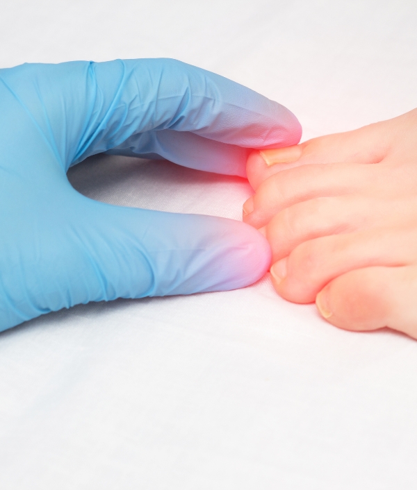 Das Bild zeigt Nägel die offenbar von einem Nagelpilz befallen sind. Die betroffene Stelle ist rötlich eingefärbt und hervorgehoben.