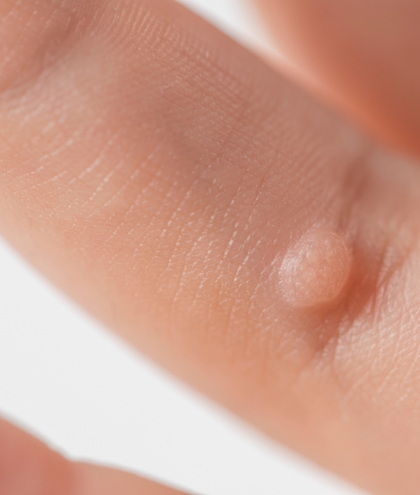 © Canva Gesundheitsrisiken durch HPV – von Warzen bis Krebs.