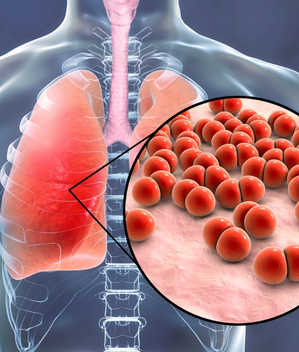 Das Bild zeigt grafisch dargestellt einen Lungenflügel mit einem vergrößerten Bild von Pneumonie Bakterien.