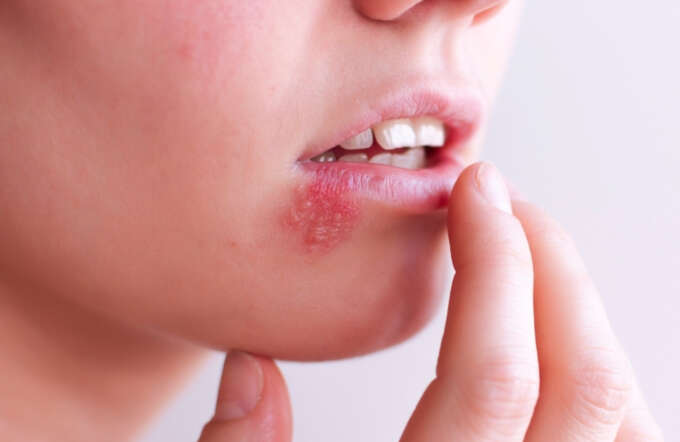 Fieberblase Lippenherpes Johann Strauss Apotheke Wien