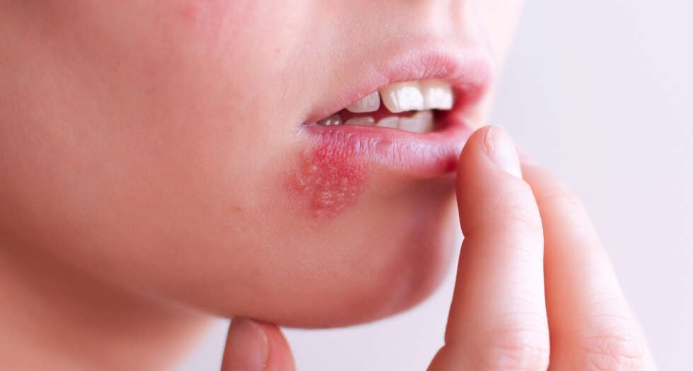 Fieberblase Lippenherpes Johann Strauss Apotheke Wien