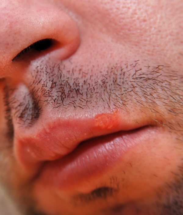 Fieberblase_Lippenherpes_Johann Strauss Apotheke Wien Fieberblase Lippenherpes Johann Strauss Apotheke Wien